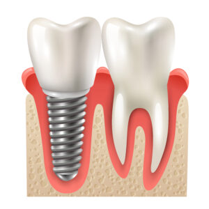 What are Dental Implants