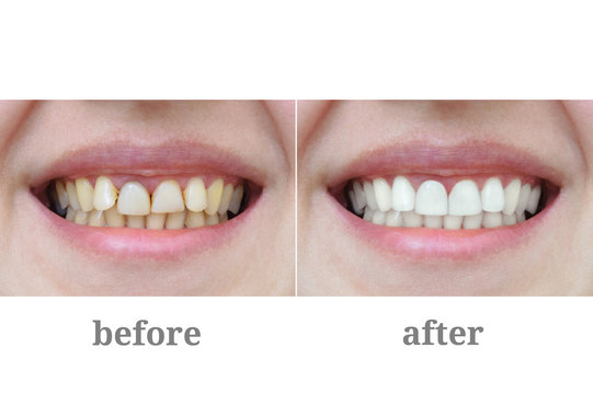 Before and After Process for Dental Implants