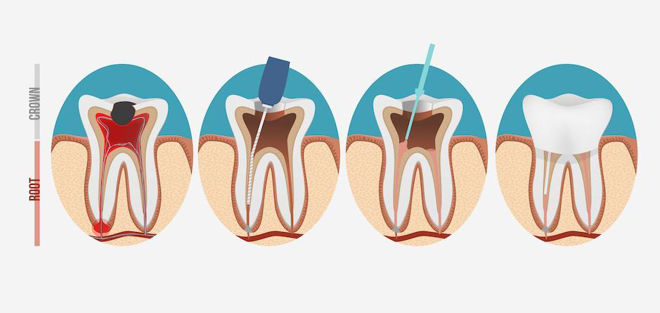 Treatment Process for Root Canal