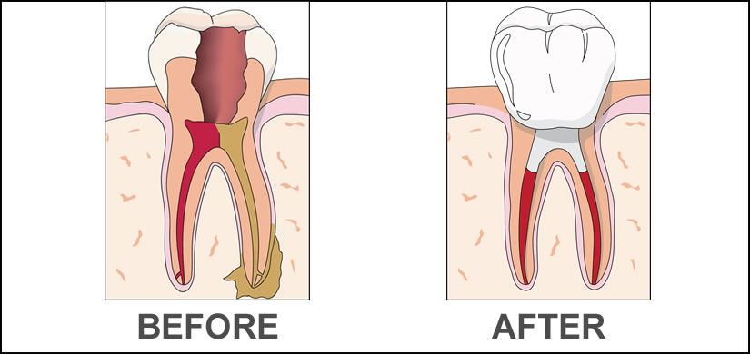 Before and After Root Canal Treatment: