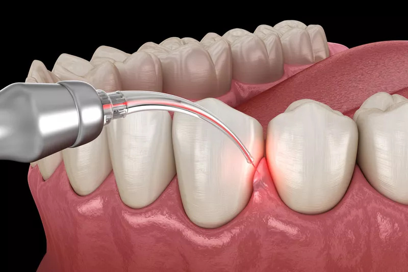 Dental laser treatment