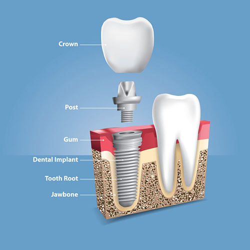 After the Implant Procedure