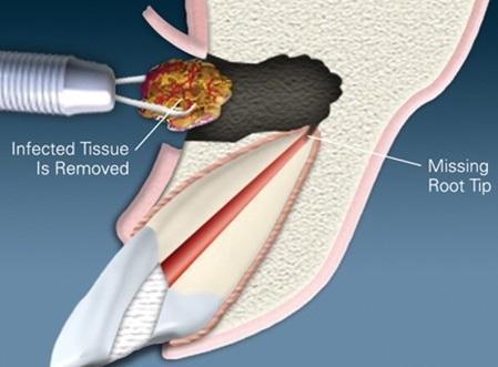 Apicectomy of Tooth