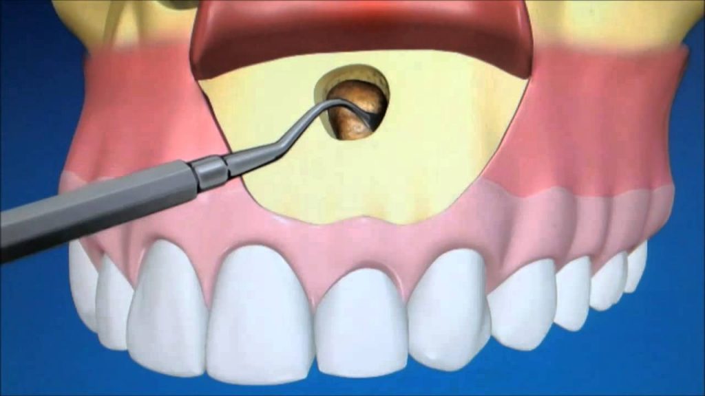 Apicectomy of Tooth