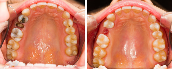 Before and After Dental Extraction