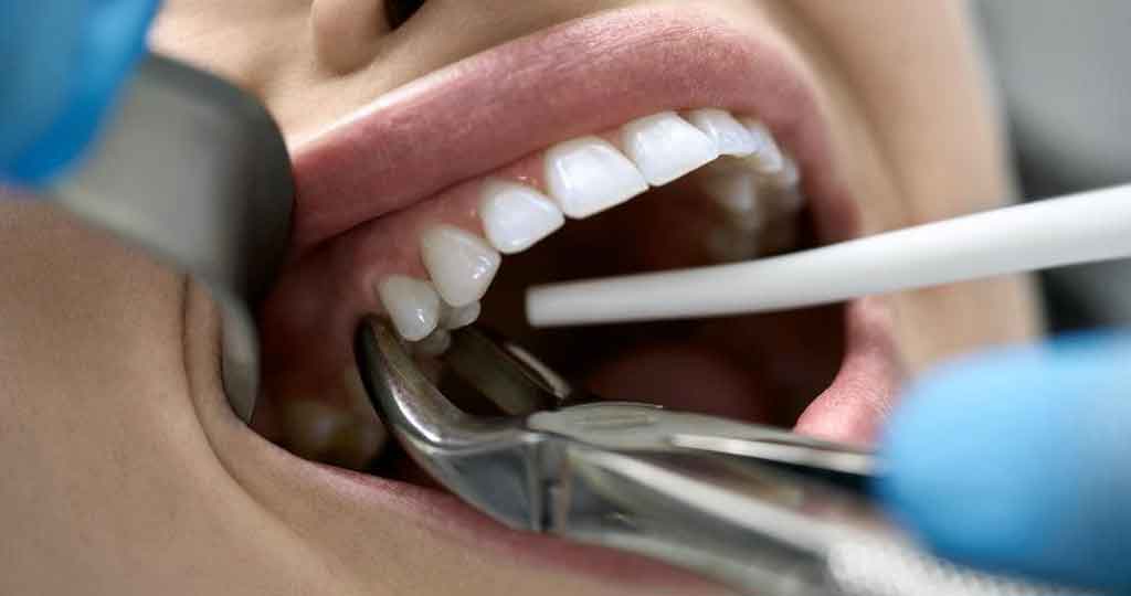 The Dental Extraction Process