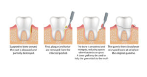 dental flap surgery