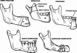 What Are Jaw Fractures?