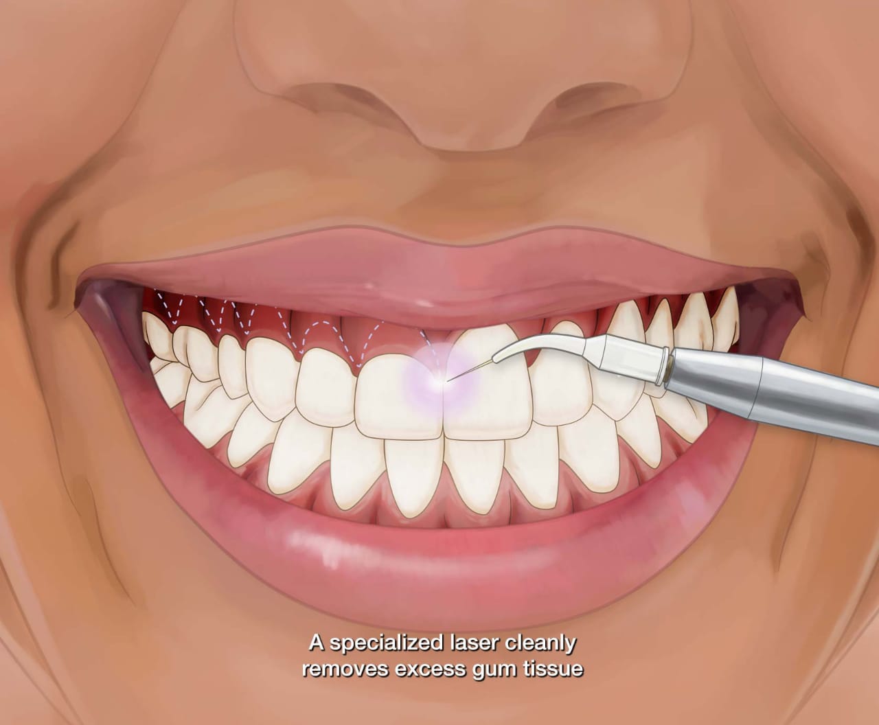 Dental laser treatment