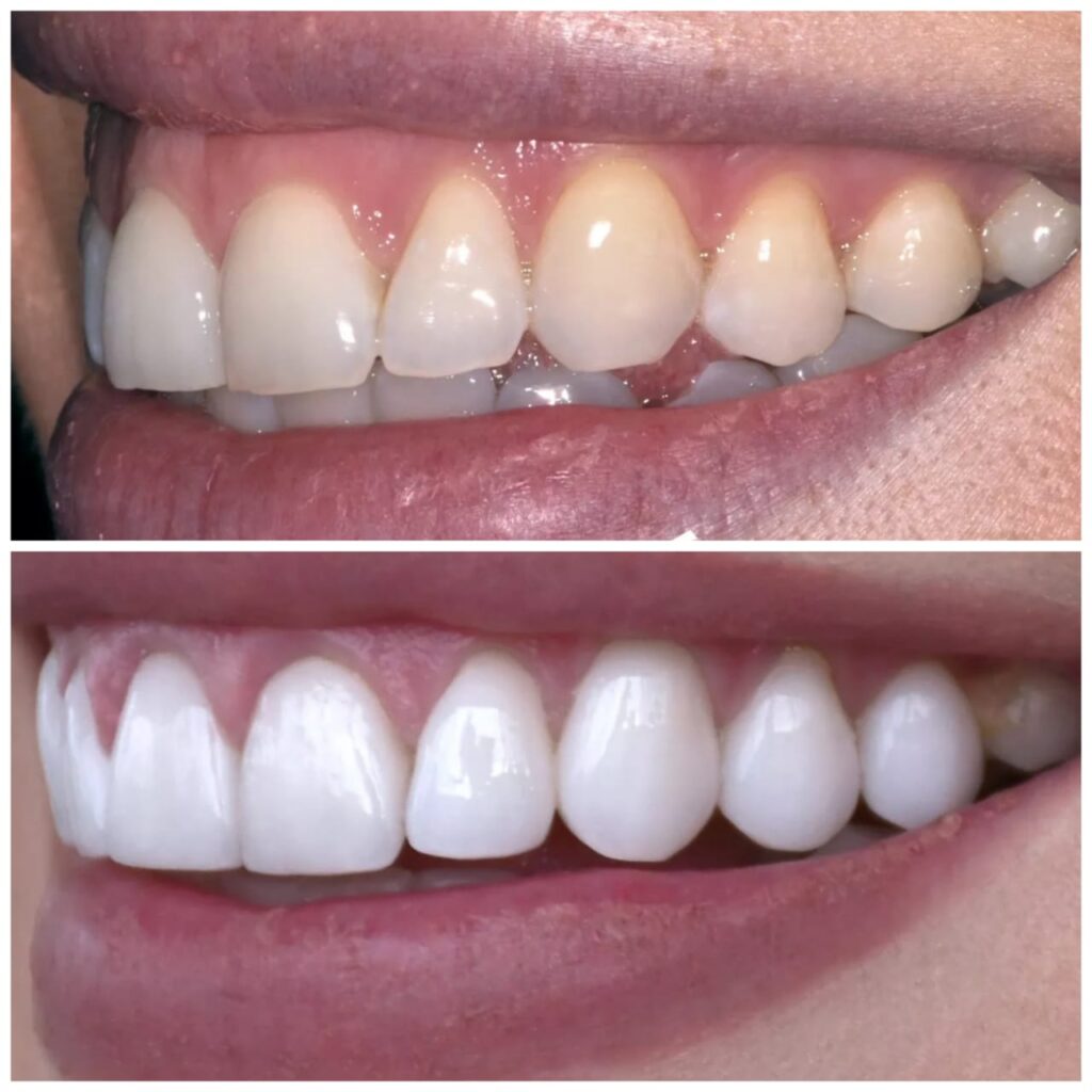 Before and After Process for Dental Laser Treatment