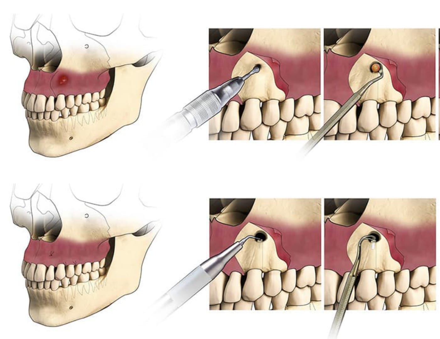 Apicectomy of Tooth