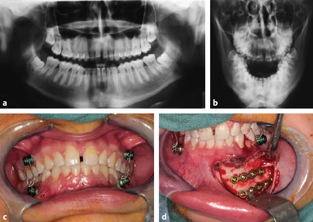 Following Treatment for Jaw Fractures