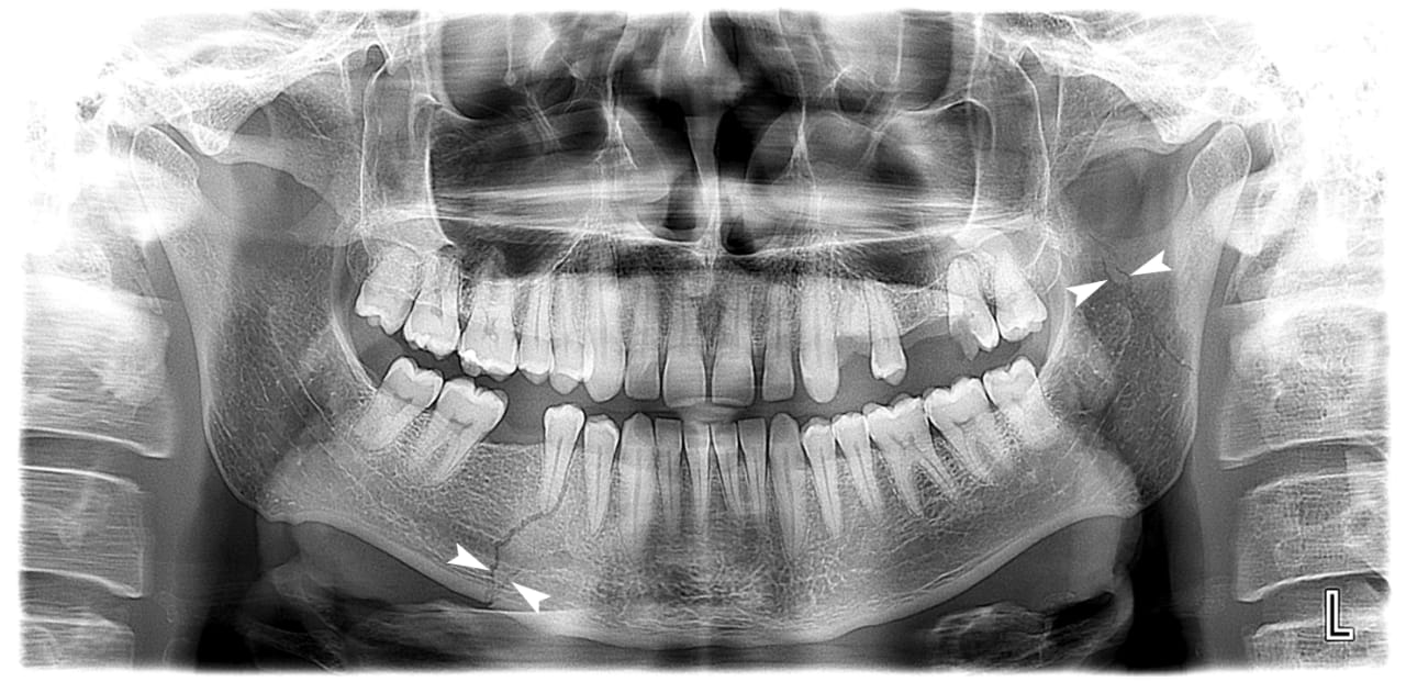 Before and After Process for Jaw Fractures