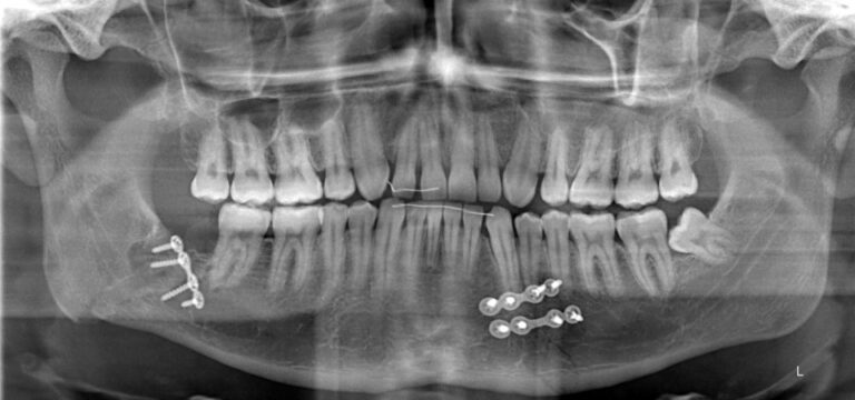 Procedure for Broken Jaw